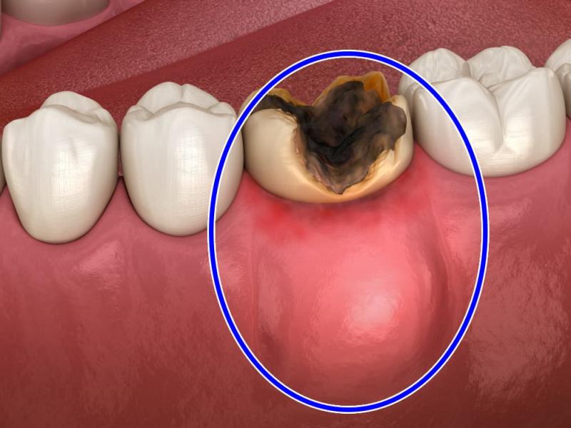 ABSCESO: Definición, Clasificación y Concepto Esencial