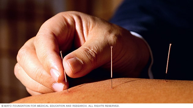 ACUPUNTURA: Definición, VENTAJAS y Concepto Esencial