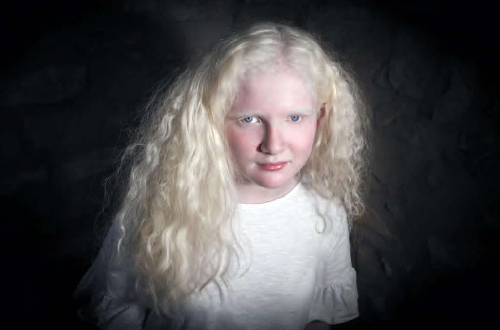 ALBINOS: Qué es el ALBINISMO y sus CARACTERÍSTICAS