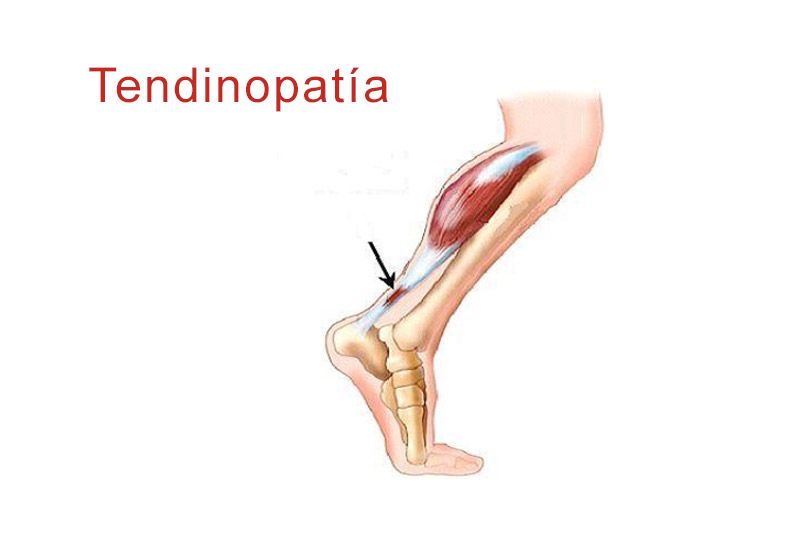 Cuáles son los tipos y conceptos clave sobre la tendinitis