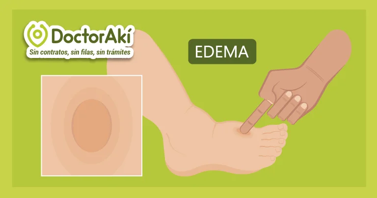 EDEMA: DEFINICIÓN y CONCEPTO CLARO que DEBES SABER