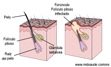 FORÚNCULO: Definición, causas y tratamiento ESENCIAL