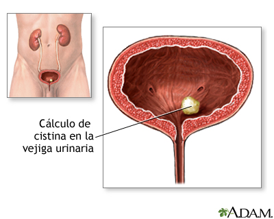 Qué es el cálculo en medicina y cuáles son sus diferentes tipos