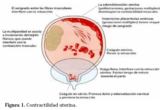 Qué es la atonía uterina, cuáles son sus causas y usos clave
