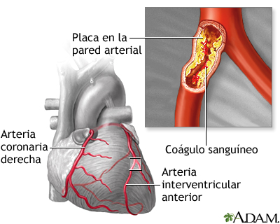 Qué es la cardiopatía y cuál es su definición esencial