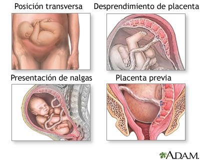 Qué es la cesárea y por qué es importante en el parto