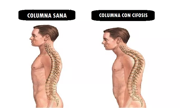 Qué es la cifosis y cuál es su definición y concepto esencial