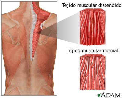 Qué es la distensión y cuál es su importancia en la salud