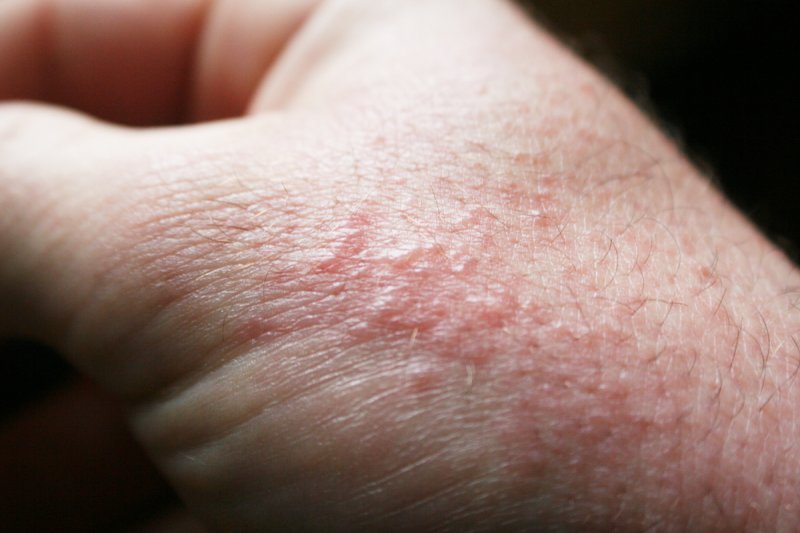 Qué es un rash, qué tipos existen y cuáles son sus causas