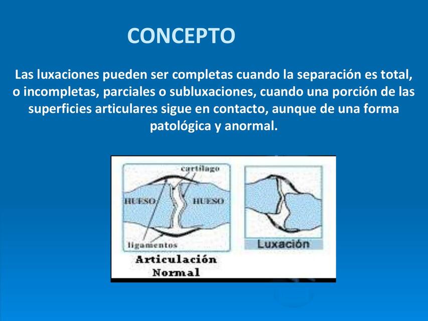 Qué Es una Luxación Definición y Conceptos Clave Relacionados