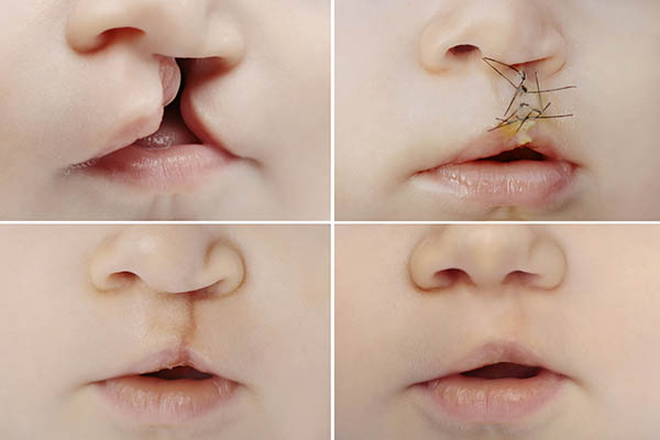 Qué son los labios leporinos y por qué son tan importantes