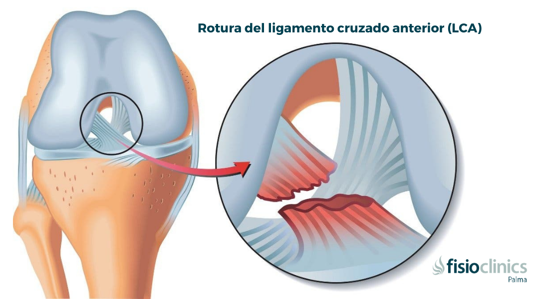 Qué son los ligamentos y por qué son cruciales para el cuerpo