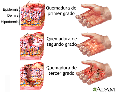 TIPOS DE QUEMADURAS: CLASIFICACIÓN Y CONSECUENCIAS