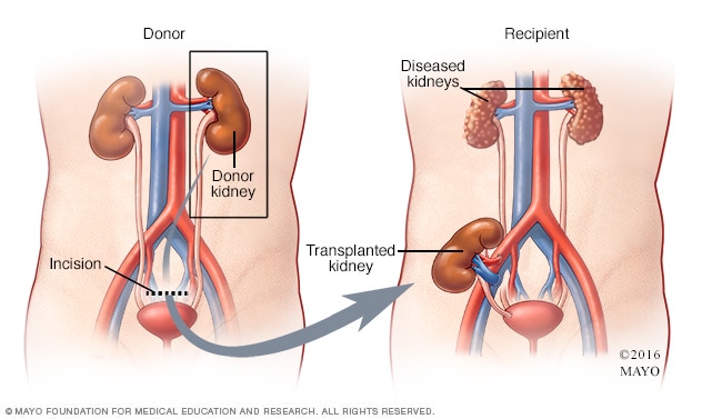 TRANSPLANTE o TRASPLANTE: Cuál es la forma correcta